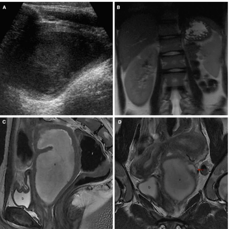 Fig. 3. Images in a 16-year-old girl who presented to the emergency department with a 2-month history of severe  pel-vic pain and anomalous uterine hemorrhage (A US; B coronal T2WI; C sagittal T2WI; D, E coronal T2WI; G coronal T2WI; H axial T2WI)