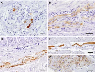 Figura 9 – Imunohistoquímica em tecidos extracerebrais em animais com PDD. A) em neurónios com infiltrado  inflamatório dos gânglios nervosos do proventrículo; B) em fibras nervosas do plexo mientérico do ventrículo; 