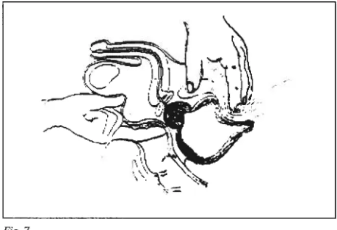 Fig. 6- 1 - normal; 2 - obstrução ligeira; 3 - obstrução moderada; 4 - obs trução grave