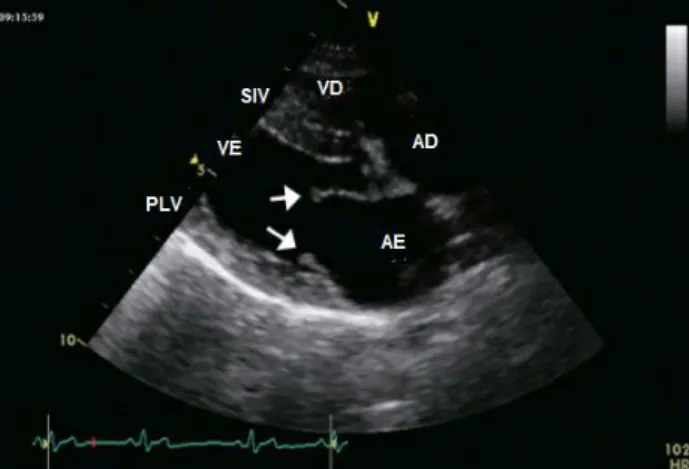 Figura  5  –  Ecocardiografia  em  modo  2D.  Plano  paraesternal  direito  transversal,  imagem  ao  nível  da  valva mitral