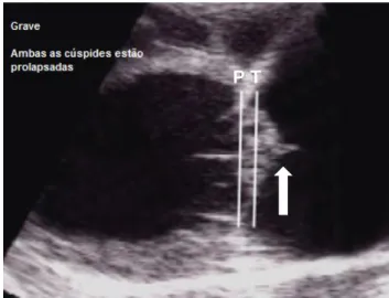 Figura  8  –  Ecocardiografia  em  modo  2D.  Plano  paraesternal  direito  longitudinal,  imagem  de  quatro  câmaras