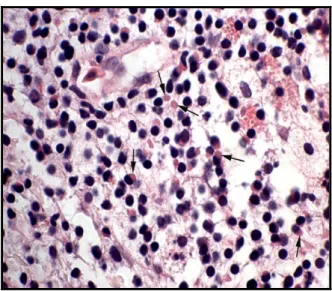 Figura  4.  Tonsila  esofágica  de  Boa  constrictor  com  IBD.  Coloração  H-E.  Numerosas  inclusões  eosinofílicas intracitoplasmáticas (setas) em células linfoides (adaptado de Chang e Jacobson, 2010)