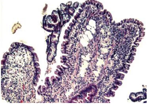 Figura 11 - Fusão de vilosidades duodenais de um  cão  com  enterite  linfoplasmocitária  (Adaptado  de  Washabau, 2013)