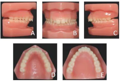 Figura 2 - Relação dentária de Classe II, divisão 1 de Angle. Vista lateral direita (A), esquerda  (C) e frontal (B)