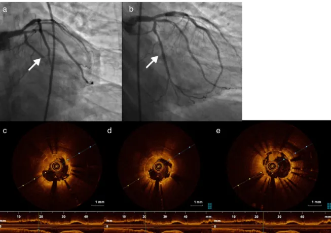 Figure 4 (a) Stent thrombosis in the first marginal; (b) first marginal after thrombus aspiration and stent placement; (c-e) thrombus in the first marginal documented by optical coherence tomography.