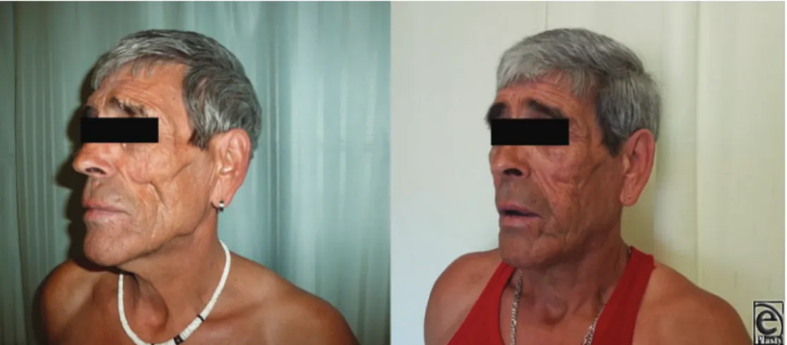 Figure 2. Pre- and postoperatively at 1 year: side.