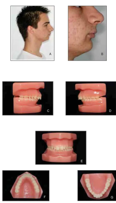 FIGURA 1- Características de paciente para a amostra. Imagem da face e oclusão. A. Perfil  com características de padrão facial II, B