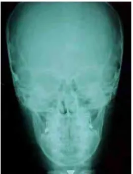FIGURA 11 – Telerradiografia  Cefalométrica em norma frontal com os 