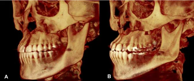 Figura 1 - Reconstrução volumétrica das TCFC de pacientes submetidos à ERMAC realizadas com  duas  osteotomias  da  parede  lateral  de  maxila