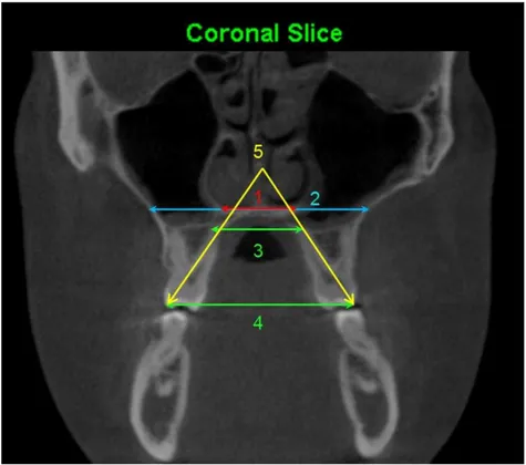 Figura  3  -  Medidas  realizadas  na  região  posterior  da  maxila  ao  nível  dos  primeiros  molares  superiores: (1) Largura do assoalho nasal: medida a partir da porção mais inferior do assoalho nasal,  no corte coronal determinado pelo ápice da raiz