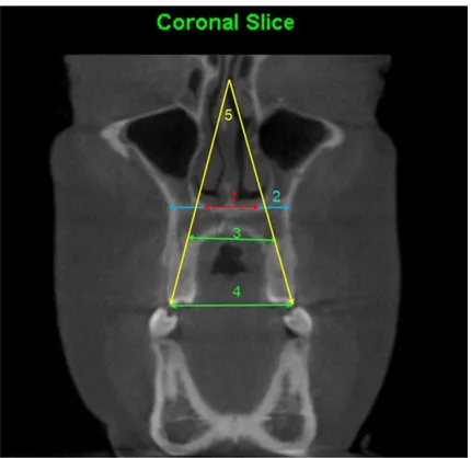Figura  4  - Medidas  realizadas  na  região  anterior  da  maxila  ao  nível  dos  primeiros  pré-molares  superiores: (1) Largura do assoalho nasal: medida a partir da porção mais inferior do assoalho nasal, no  corte  coronal  determinado  pelo  ápice  