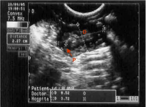 Figura  11.  Imagem  ultra-sonográfica  do  corno  uterino  direito  de  cadelas  no  dia  0  (parto)
