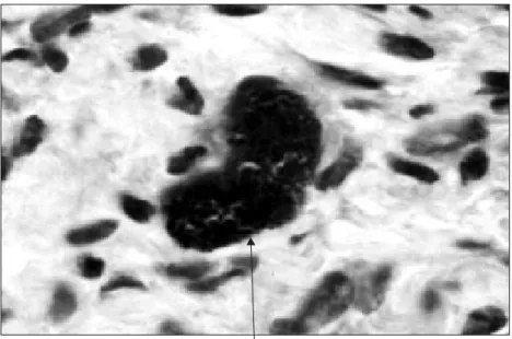 Fig. 2 — Microscopic morphology of gram-negative bacterial aggregates around the nucleus of splenic autotransplant macrophages (gram – 1.000 x).