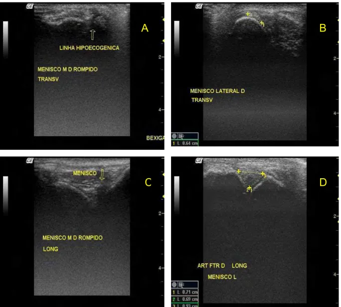 Figura 5: Sonogramas da articulação femorotibiopatelar de um cão ex vivo com: A  lesão meniscal intra-articular - plano transversal articular verificando estrutura linear  espessa e hiperecogênica dorsal ao côndilo lateral da tíbia, porém com uma linha  hi