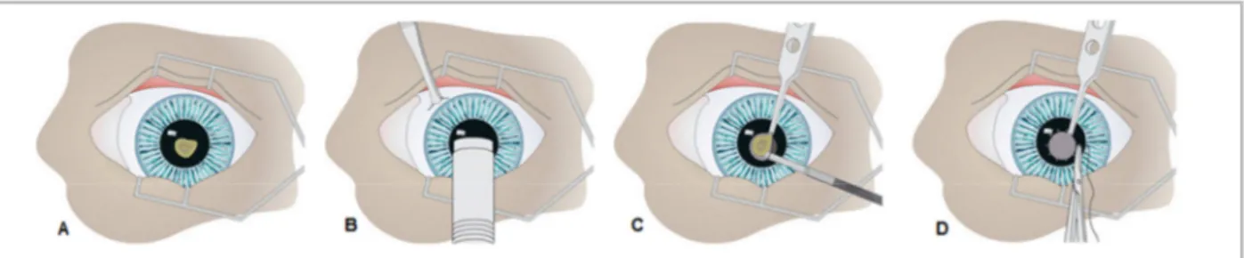 Figura  15  –  Representação  de  uma  queratoplastia  lamelar.  A,  Úlcera  corneal;  B,  Incisão  a  0,25-0,35  mm  de  profundidade;      