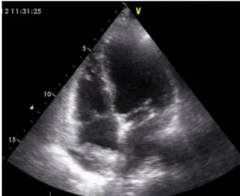 Figure 1 Initial assessment by transthoracic echocardiog- echocardiog-raphy (apical 4-chamber view), showing a heterogeneous echodense image (3 cm × 2.2 cm) adhering to the right atrial roof, interpreted as a thrombus.