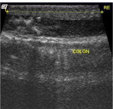 Figura  3.  Imagem  ultrassonográfica  em  plano  longitudinal  da  porção  terminal  das  alças  intestinais (colon) de cascavel (Caudisona durissa terrifica)
