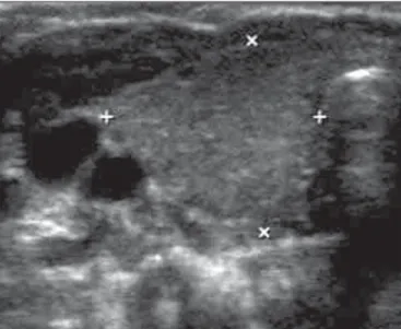 Figura 1. Ultrassonografia da região cervical. Observar o lobo tireoidiano direito (entre os marcadores) de uma criança assintomática