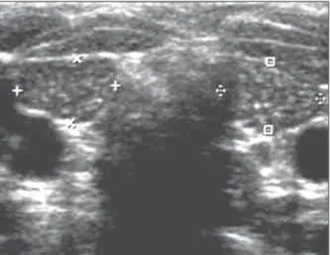 Figura 2. Ultrassonografia da região cervical. Nesta imagem se observa a glân- glân-dula tireoide com dimensões reduzidas e hipoecogênica (entre os marcadores).