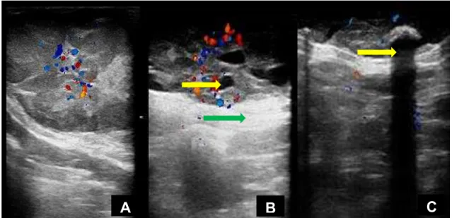 Fig.  2-  Imagens  ultrassonográficas  dos  tumores  benignos;  A)  Tumor  misto  benigno: 