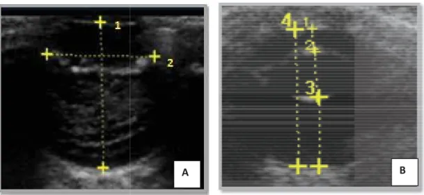 Figura 1. Mensurações da plano dorsal do bulbo ocu comprimento axial em 1  Imagem ultrassonográfica e mensurações: 1- câmara an