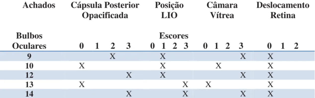 Figura 5. Imagem ultrassonog câmara vítrea com Hialose Asteróide: onde s ão de câmara vítrea (seta)