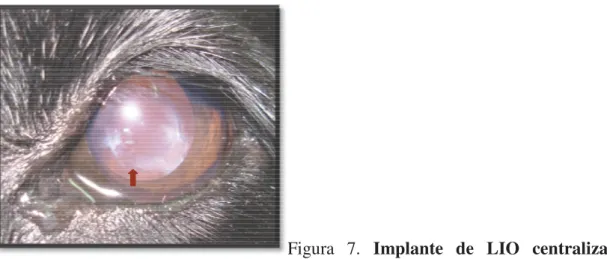 Figura 7. Implante de LIO bo ocular do grupo PL, onde se pode observ