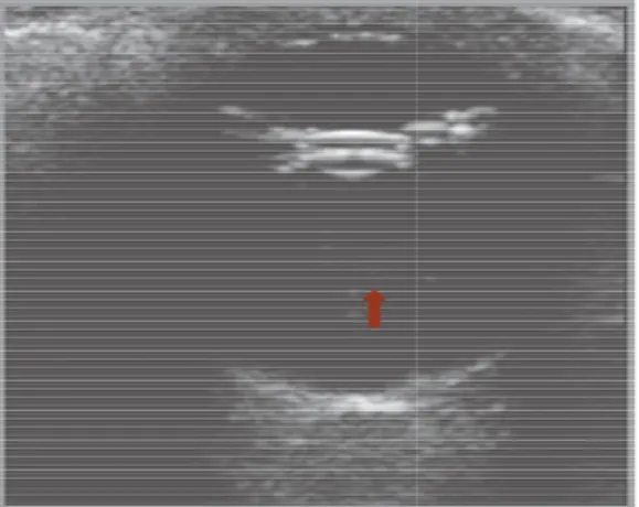 Figura 9. Imagem ultrassonog e animal do grupo PP, da câmara vítrea cl dia grau 1, onde se observam poucos po (seta)