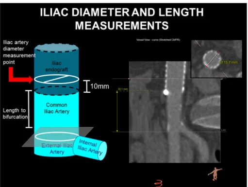 Figure 1. Method for serial length and diameter measurements at the iliac sealing zone.