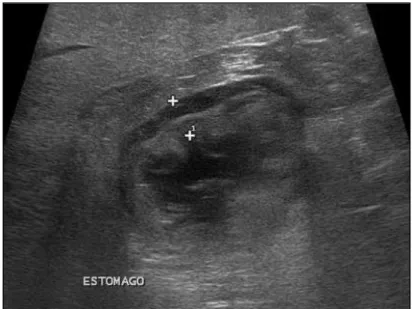 Figura 3. Imagem ultrassonográfica demonstrando um espessamento simétrico e extenso da parede gástrica em  um cão, predominantemente da camada muscular