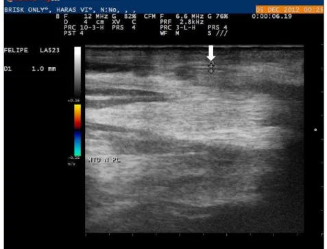 FIGURA 7: Ultrassonografia em modo B com a mensuração do diâmetro crânio caudal  realizada no nervo palmar lateral do membro torácico direito de um equino (seta)