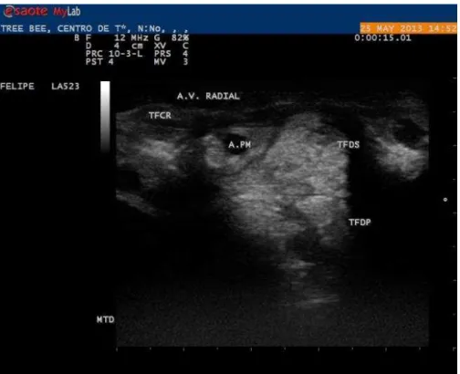 Figura 15: Imagem em corte transversal na região distal do rádio e na fileira proximal  dos ossos cárpicos observando a transição de fibras musculares para fibras tendíneas