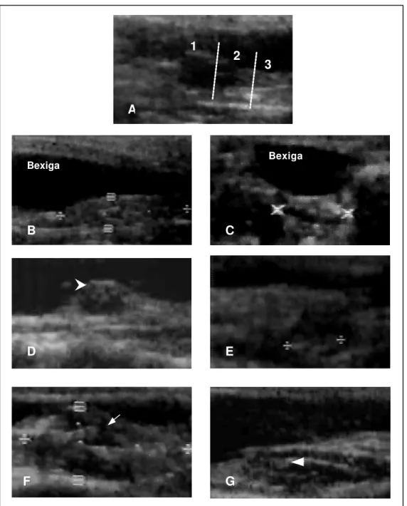 Figura 11  – Imagens ultra-sonográficas do útero  Aotus azarai infulatus . (A) Corte sagital mostrando útero  simples, de formato alongado, posicionado ventralmente à bexiga, apresentando três regiões  caracterizadas como fundo (1), corpo (2) e cérvice (3)