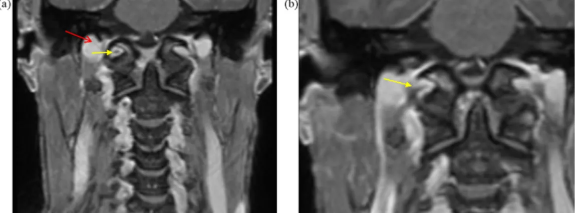 Fig. 5. (a) Coronal T1WI with intravenous contrast through the proximal hypoglossal canal, displaying the typical round morphology at its proximal level