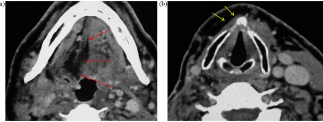 Fig. 8. (a) Axial CT showing marked hypodensity in the right hemitongue, secondary to fatty inﬁltration in a patient with hypoglossal palsy due to metastasis