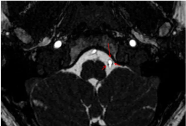 Fig. 10. Axial CISS. Slightly thickened right hypoglossal nerve (yellow arrow) in close contact with the ipsilateral vertebral artery (red arrow)