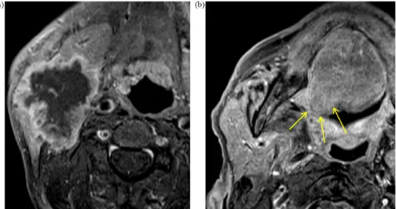 Fig. 14. (a) Axial T1WI with intravenous contrast showing a large necrotic adenopathy in the right submandibular space with invasion of the hypoglossal loop