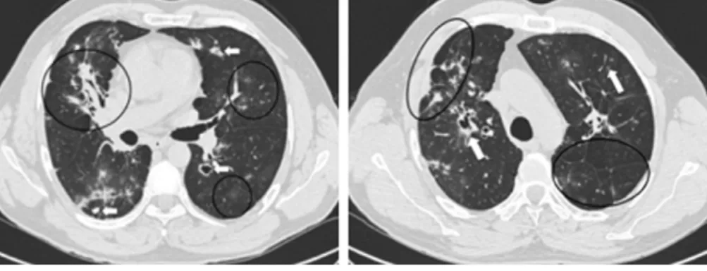 Figura 2 Aspetos em TCAR pulmonar.