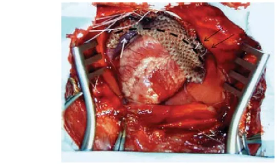 Figura 1. Preparação de tórax-aberto do coração de coelho, com rede de nylon suportando eléctrodos monopolares ao longo das aurículas (da aurícula direita lateral-alta até à aurícula esquerda lateral-alta)