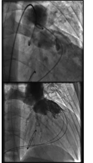 Figura 2. Angiografia do tracto de saída do ventrículo direito durante a diástole, antes(A) e depois (B) da IPVP, notando-se a resolução da insuficiência pulmonar