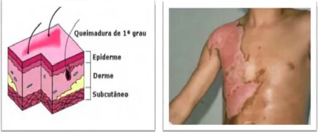 Figura 1 - Refere-se a queimadura de primeiro grau demonstrando o comprometimento da  epiderme
