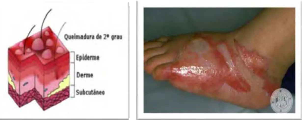 Figura 2 - Refere-se a queimadura de segundo grau  demonstrando o comprometimento da  epiderme e parte da derme