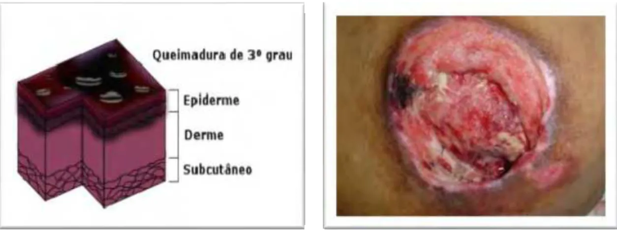 Figura 3 - Refere-se a queimadura de terceiro grau  demonstrando o comprometimento da  epiderme,  derme e tecido subcutâneo