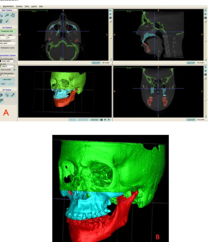 Figura  5  ‐  A.  Segmentação  das  áreas  alteradas  pela  cirurgia  (maxila  e  mandíbula)  no  software ITK‐SNAP 2.2.4,  após o registro  B. Close up do Modelo tridimensional completo  finalizado.            