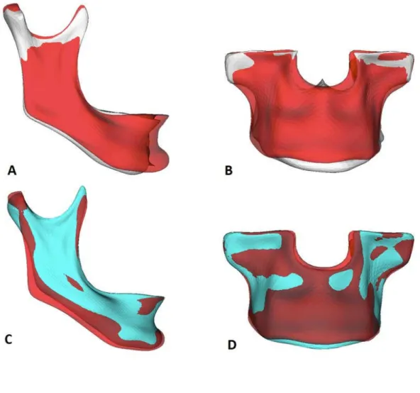Figura  7  ‐  A  e  B.  Mapa  de  semi‐transparências  da  mandíbula  e  maxila  representando  os  deslocamentos  cirúrgicos  ocorridos  ‐  T2  (vermelho)  ‐  T1  (branco).  C  e  D.  Mapa  de  semi‐