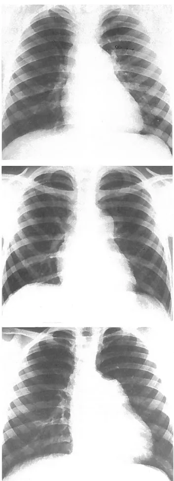 Figura 1: Fonocardiograma do caso 4. Registo obtido no 3.° espaco intercos tal esquerdo; curio sopro diastOlico (S.D.).