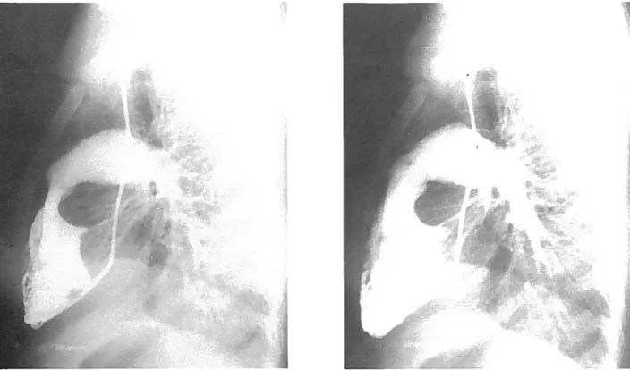 Figura 5: Angiocardiografia selecliva do ventrIculo direito do caso I, em perfil. a - em sIsfole, b - em diásfole.