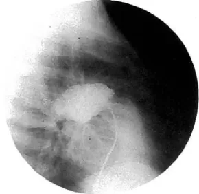 Figura 7: Cineangiocardiografia, caso 4. InjecçAo de contraste no tronco da artéria pulmonar