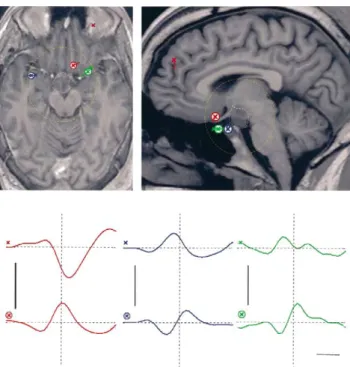 Fig. 2. Recursively applied multiple signal classification (Rap-MUSIC) analysis for patient 1, with source localization and their activation curves.