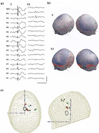 Fig. 5. Patient 3: (a) Spike types as seen in the raw (non-averaged) EEG.